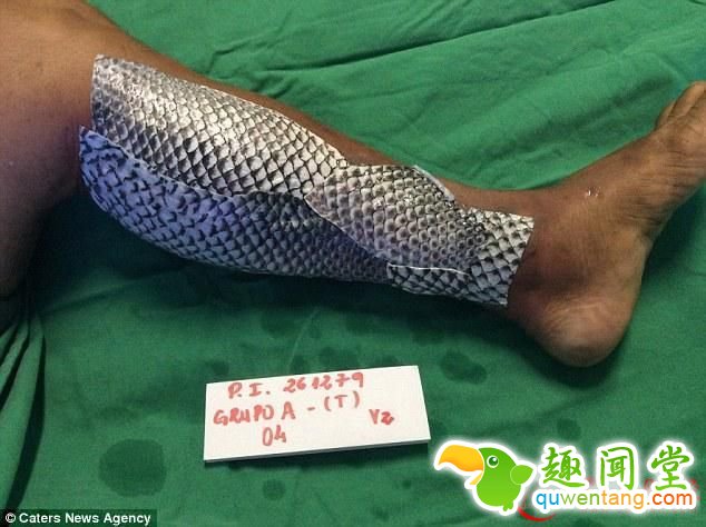 女子手臂烧伤后植入鱼皮有弹性 竟有如此神效！