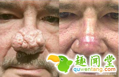 男子懒得挤痘痘竟然累积上百颗才去弄！最后用挤的不成~居然还...网友看了超震惊！