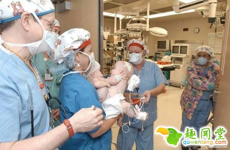 世界最罕见的连体婴，长大分开后的人生是这样