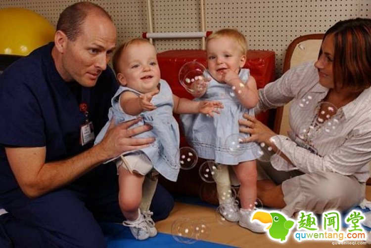 世界最罕见的连体婴，长大分开后的人生是这样