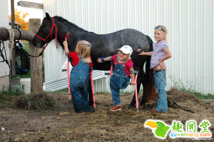 世界最罕见的连体婴，长大分开后的人生是这样