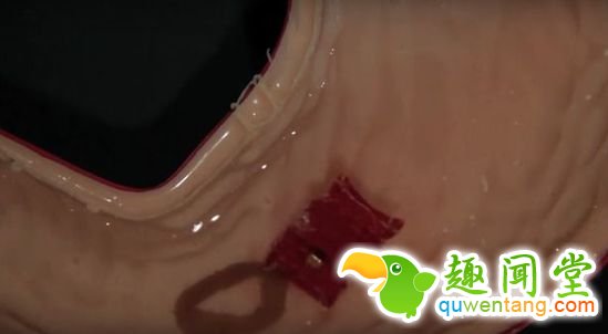 不慎吞下异物怎么办？那再吞一个机器人吧