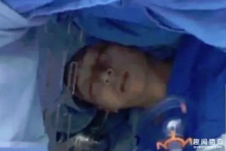 他开颅手术中醒来　淡定喊医生：帮我抓一