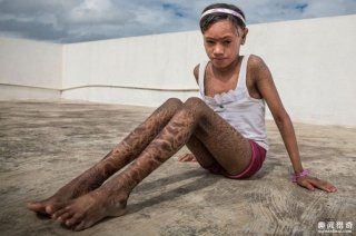 全身长满蛇皮，印度姐弟被全村人当成了妖