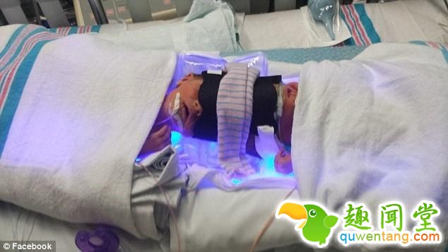 连体婴儿奇迹般存活！24小时的手术没有压倒美国这对双胞胎