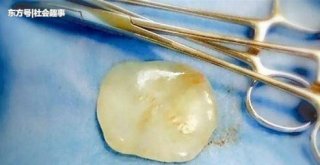 女婴带“玉”出生 医生介绍称全世界罕见