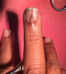 巴基斯坦男子中指长出小指甲 长度小于1厘